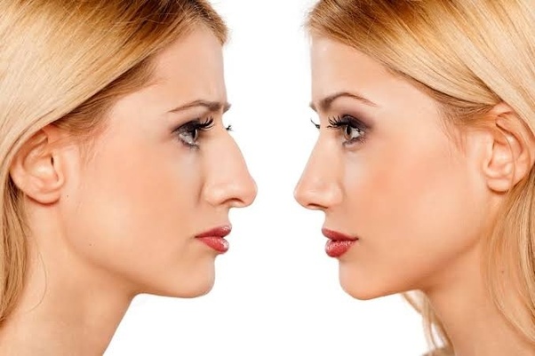 Nose Job Washington DC Enhances Facial Symmetry